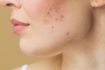 An Easy Guide On How to Care for Acne Prone Skin