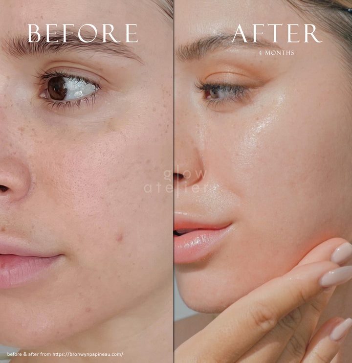 The glass ipl photofacial review before and after does it work is it a scam real review ipl skincare for acne prone dry skin types